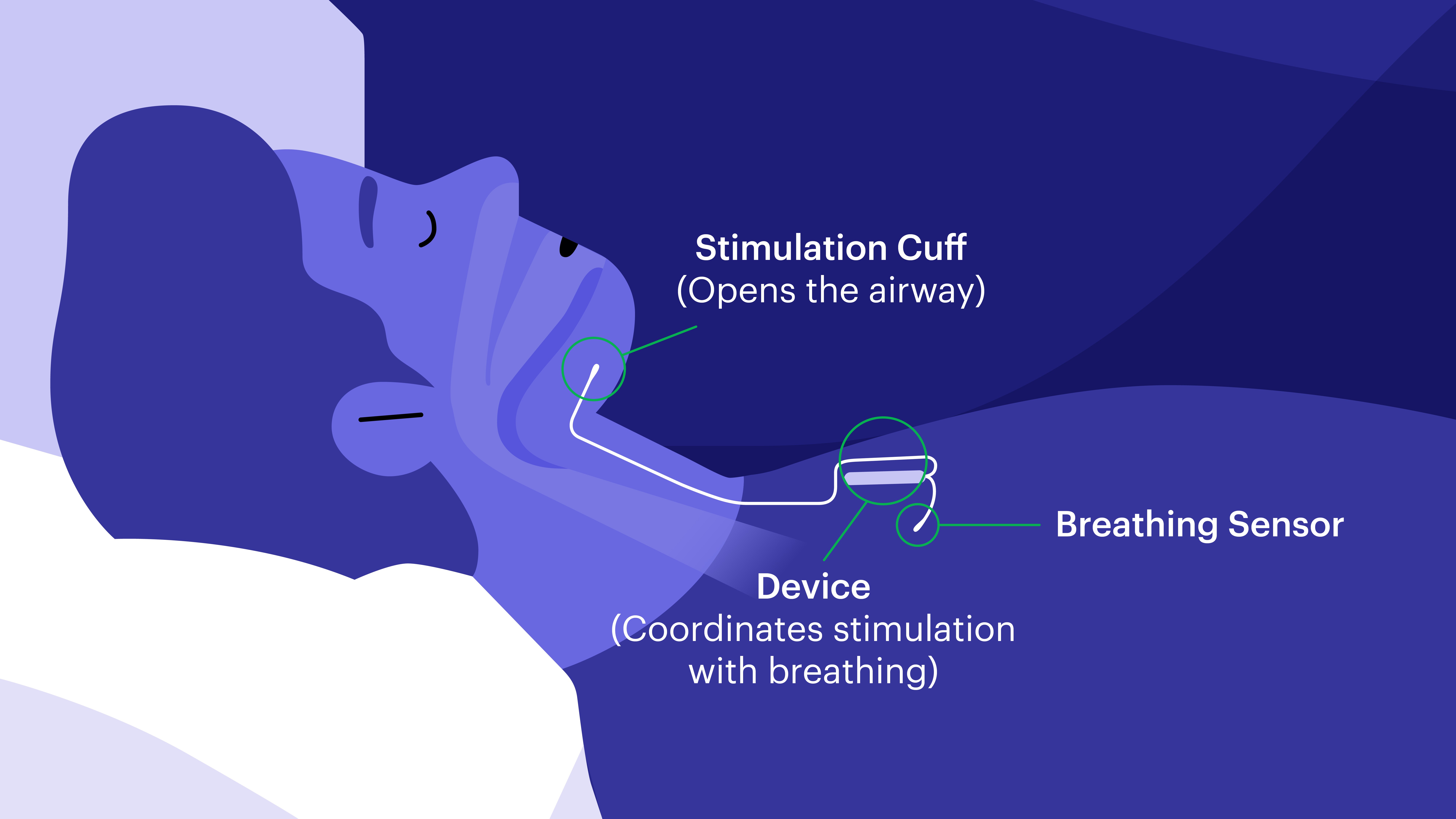 Inspire sleep apnea treatment Inspire sleep apnea treatment